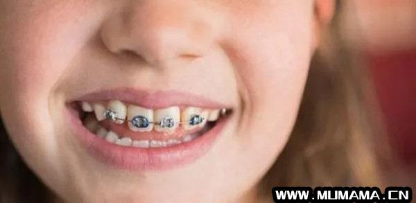 儿童换牙注意事项，需注意这5个方面