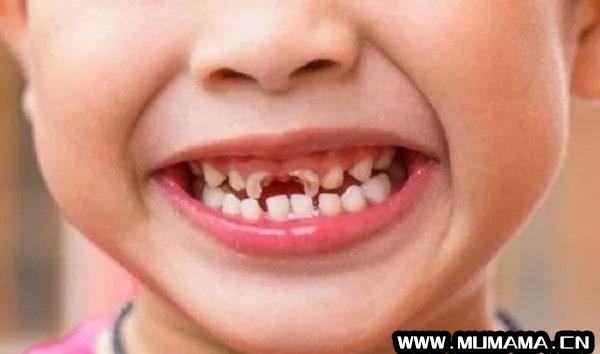 儿童换牙注意事项，需注意这5个方面(儿科常见病诊断与治疗)