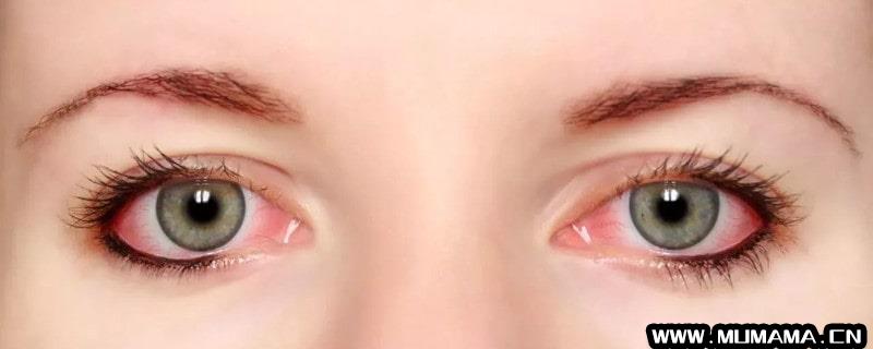 孕妇得了红眼病能自愈吗(在治疗红眼病的时候要特别注意哪些)