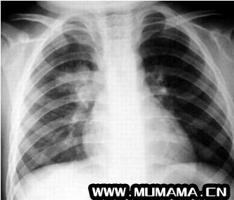 小儿支气管肺炎和小儿肺炎的区别 警惕小儿咳成肺炎