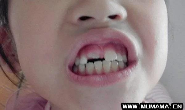 儿童换牙注意事项，需注意这5个方面