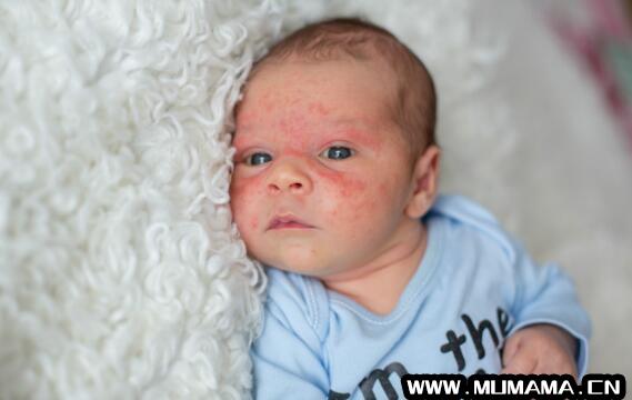 宝宝长湿疹了，怎么挑选湿疹膏才有效？