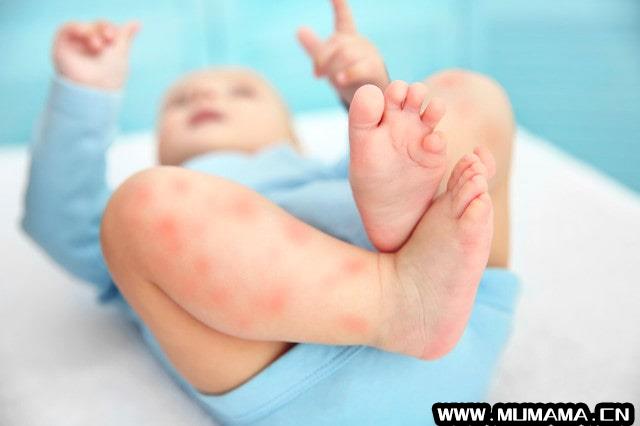 怎么判断宝宝是过敏还是长湿疹？