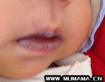 婴儿嘴唇发紫是什么原因