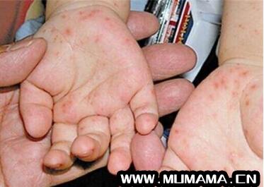 手足口病初期症状图 教你辨别手足口病潜伏期