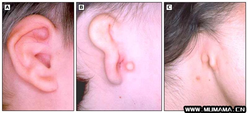 宝宝耳朵看起来很小是什么原因？(头皮上长痘痘是什么原因)