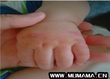 手足口病初期症状图 教你辨别手足口病潜伏期