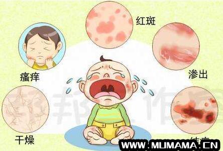 新生儿湿疹的症状及护理方法
