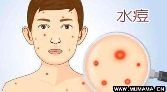 水痘的护理和预防(长水痘很容易传染)