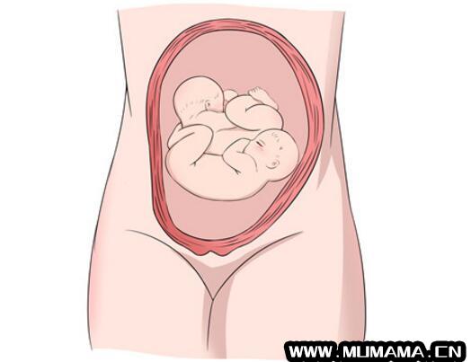怀了双胞胎，准妈妈只能做剖宫产吗？