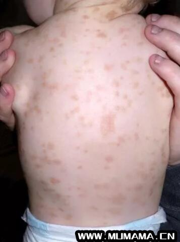 儿童荨麻疹