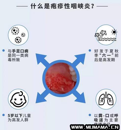 如何防治疱疹性咽峡炎