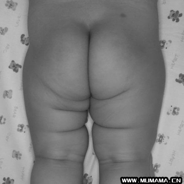 为什么宝宝的臀纹不对称？是髋关节发育不良吗？(孩子腿纹臀纹不对称就是髋关节发育不良吗)