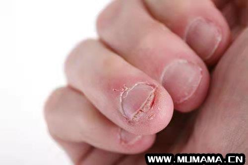 啃指甲怎么恢复指甲，指甲咬的很短能恢复吗(孩子指甲这4种表现是患病信号)