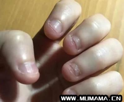 经常咬指甲甲床变短怎么恢复，长期咬指甲还能恢复吗(总是喜欢咬指甲)