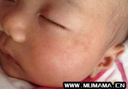 奶粉过敏和湿疹的区别，奶粉引起的湿疹图片