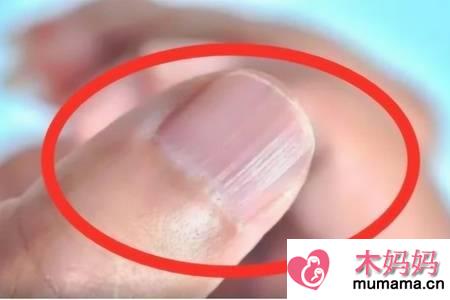 指甲上有竖纹是怎么回事,教你改善指甲竖纹的方法