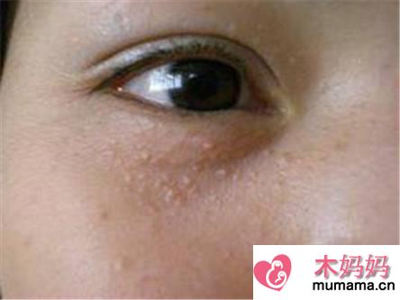 眼部扁平疣的症状和治疗方法 保护好心灵的窗户
