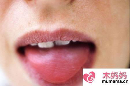 舌苔厚白的原因,除了上火还有可能是这种疾病