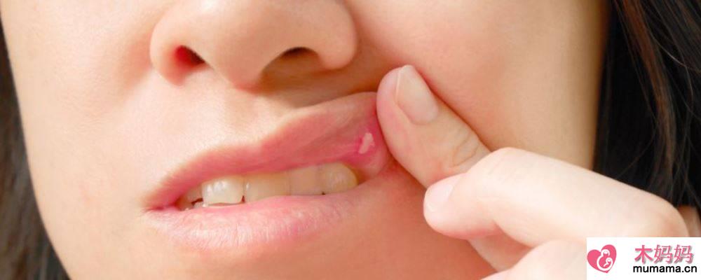 口腔溃疡怎么办？有哪些治疗的小偏方？