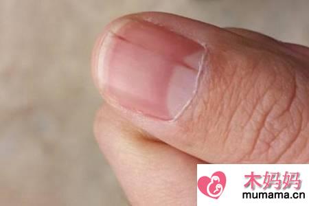 指甲上有竖纹的产生原因，这一种大病征兆要小心预防