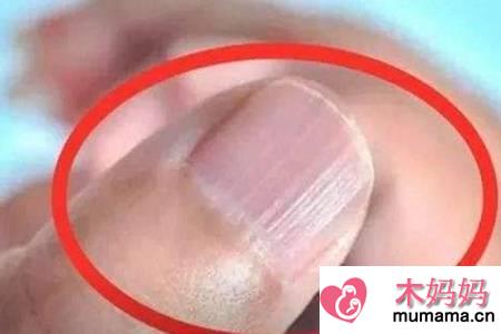 指甲上有竖纹是怎么回事?指甲竖纹多注意是疾病的征兆