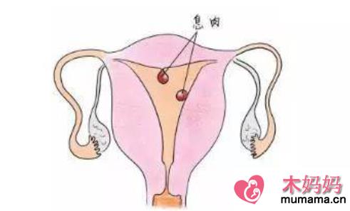 发现息肉就要手术吗 子宫内膜息肉切除标准是什么