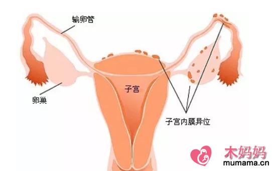子宫内膜异位症手术后能怀孕吗 子宫内膜异位症会痛经吗