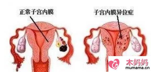 子宫内膜异位症手术后能怀孕吗 子宫内膜异位症会痛经吗