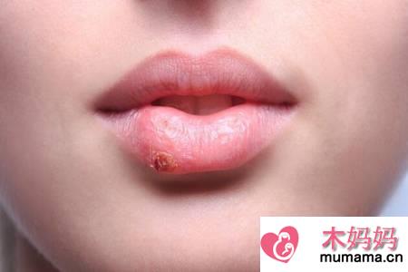 口腔疱疹症状有哪些？这三个口腔疱疹病毒感染的症状