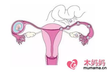 预防宫外孕的运动有哪些 跳绳能够预防宫外孕吗