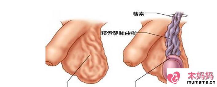 精索静脉曲张更容易发生在左侧蛋蛋吗 左侧精索静脉曲张会引发右侧精索静脉曲张吗