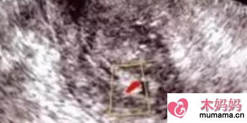 子宫内膜息肉的治疗方法 子宫内膜息肉影响怀孕吗