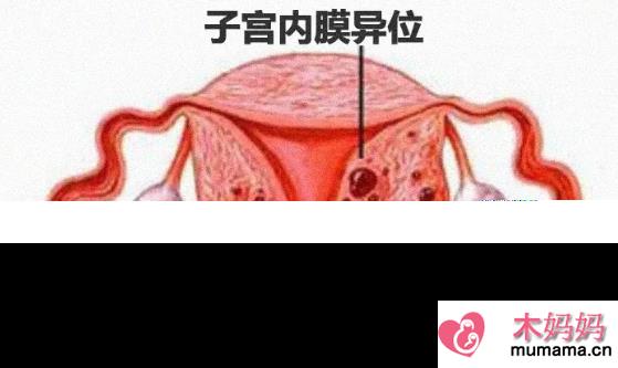 子宫内膜异位症还能怀孕吗 女性子宫内膜异位症严重吗