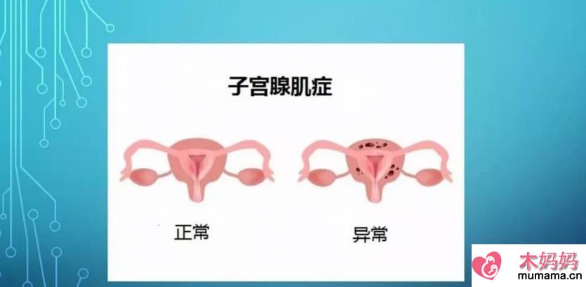 子宫肌腺症可以做试管婴儿吗 子宫肌腺症做试管婴儿成功率多少