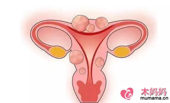 子宫内膜太厚怎么治疗 子宫内膜太厚和生活习惯有关吗