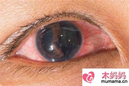 女人眼睛有红血丝或是这四种原因