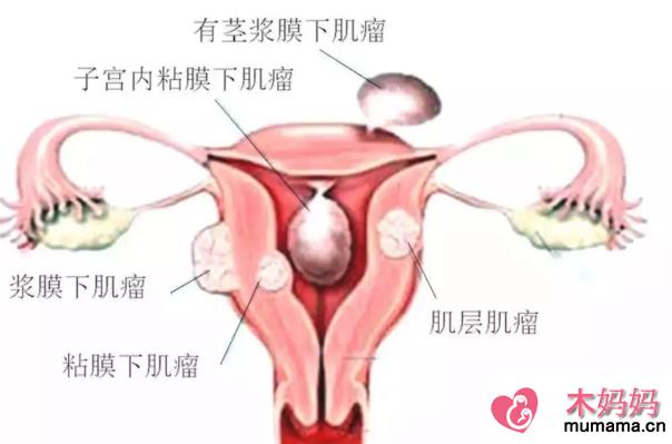 带着肌瘤怀孕会发生什么 预防子宫肌瘤吃什么好