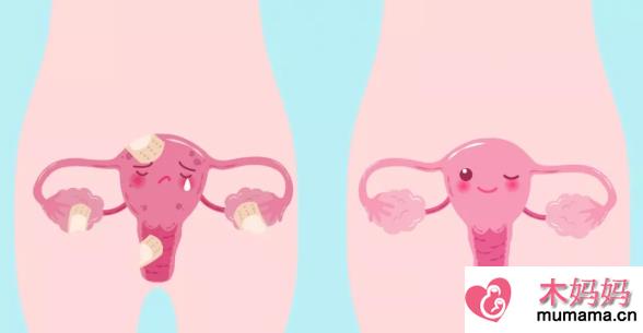 子宫畸形会造成流产吗 子宫畸形还能顺产吗