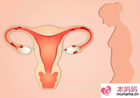 子宫内膜异位症和遗传有关吗 子宫内膜异位症能做试管婴儿吗