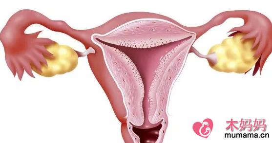 卵巢多囊样改变需要治疗治疗吗 卵巢保养吃什么好