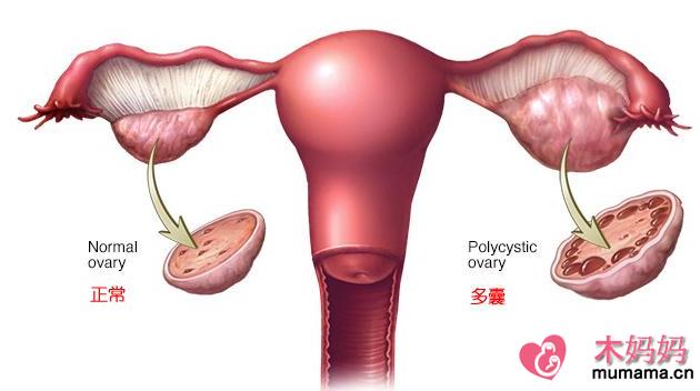 多囊卵巢综合征患者怀孕率低吗 多囊卵巢综合征怎么备孕
