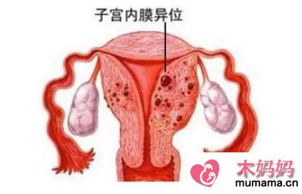 治疗子宫内膜异位症要吃避孕药吗 治疗子宫内膜异位症的方法