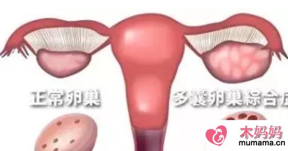 有多囊多少岁备孕合适 有多囊卵巢怎么备孕