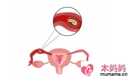 造成宫外孕的原因有哪些 宫外孕的原因介绍