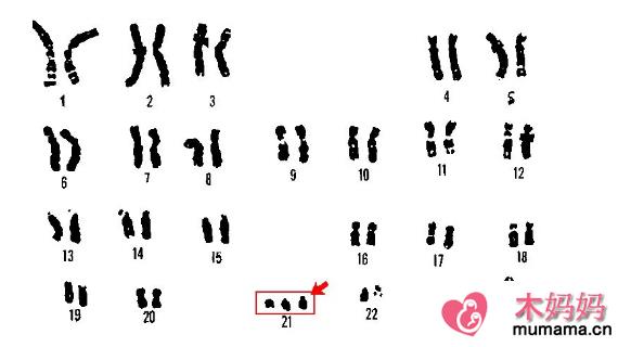 染色体平衡异位可以做试管婴儿吗 染色体平衡异位会有哪些疾病