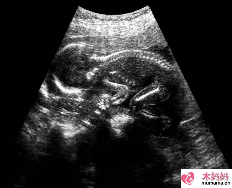 怀孕做了X光之后会怎么样 做X光后多久可以怀孕